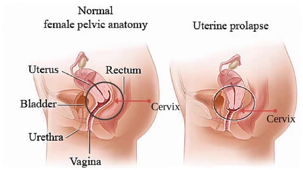 فتق واژن - بیرون زدگی واژن بعد از زایمان