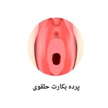  پرده بکارت حلقوی
