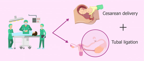 بستن لوله رحم بعد از سزارین