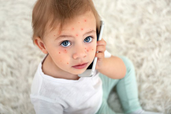 نشانه های آبله مرغان