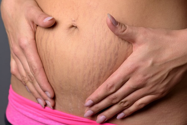 عکس ترک شکم در بارداری