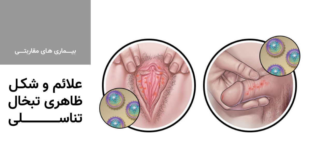انتقال تبخال تناسلی از طریق لباس + درمان تبخال تناسلی + ویروس هرپس