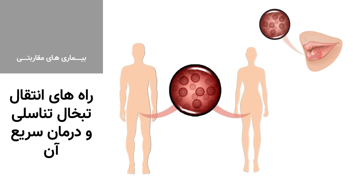 انتقال تبخال تناسلی از طریق لباس + درمان تبخال تناسلی + ویروس هرپس